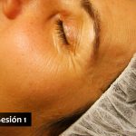 Rejuvenecimiento facial con Acupuntura y Medicina China