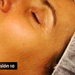Rejuvenecimiento facial con Acupuntura y Medicina China