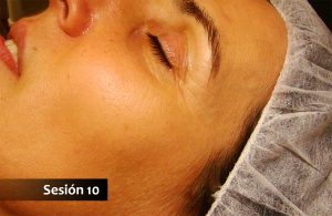 Lifting facial con acupuntura: Sesión 10
