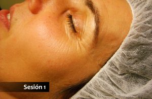 Tratamiento de lifting facial con acupuntura - Sesión 1