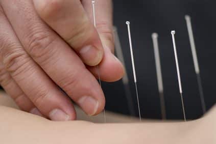 Acupuntura | Acupuncture