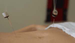 Moxa y acupuntura - Tratamiento enferemedad inflamatoria intestinal con Medicina Tradicional China